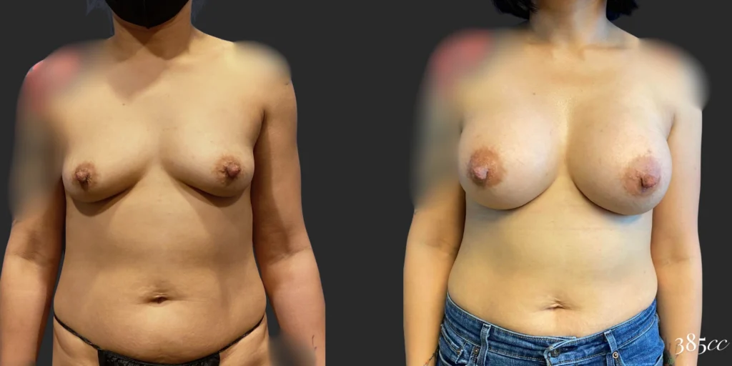 Breast Augmentation #113, before and after photo, view 3