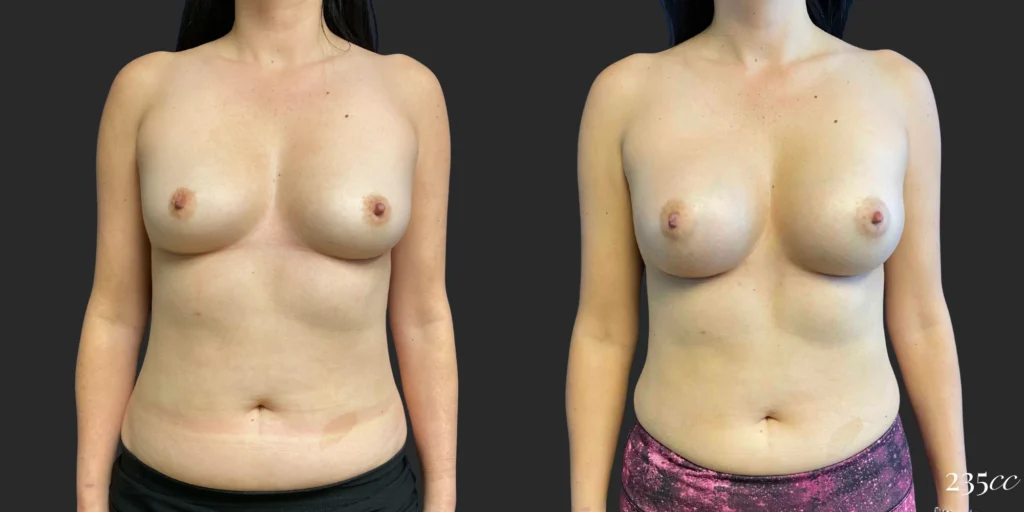 Breast Augmentation #114, before and after photo