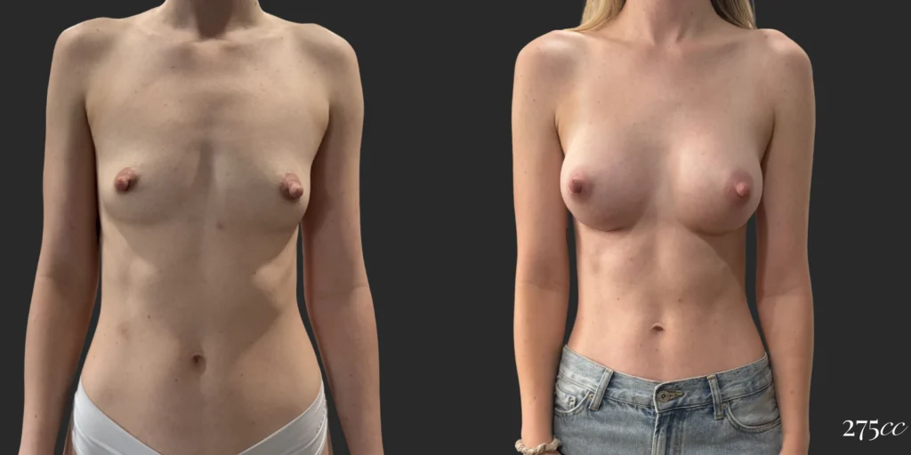 Breast Augmentation #115, before and after photo