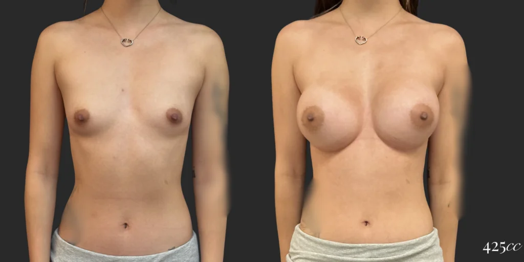 Breast Augmentation #116, before and after photo