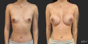 Breast Augmentation #116, before and after photo