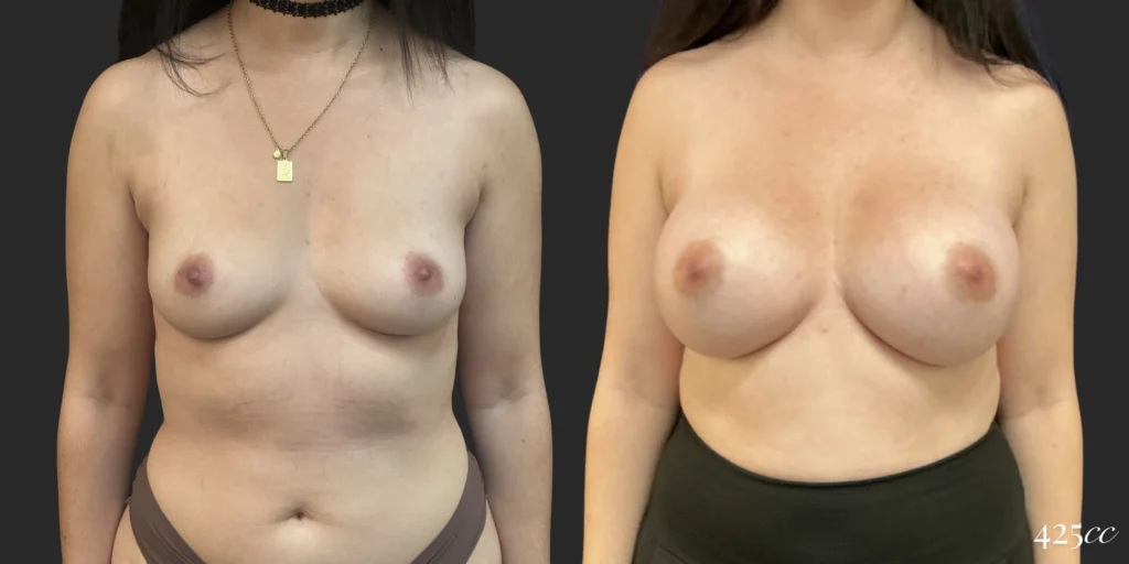 Breast Augmentation #117, before and after photo