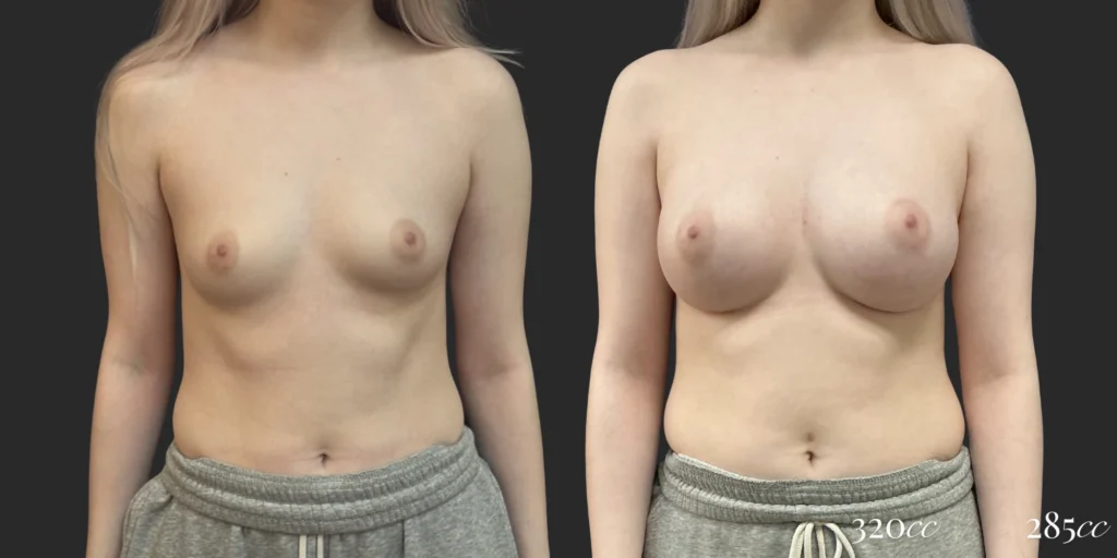 Breast Augmentation #118, before and after photo