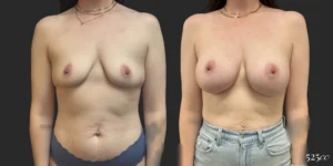 Breast Augmentation #119, before and after photo