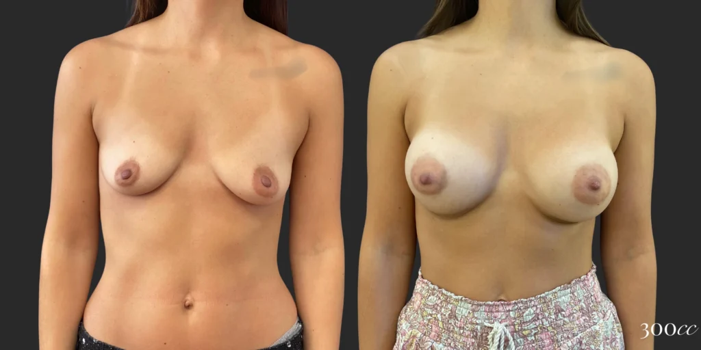 Breast Augmentation #121, before and after photo
