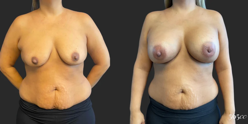Breast Augmentation #105, before and after photo