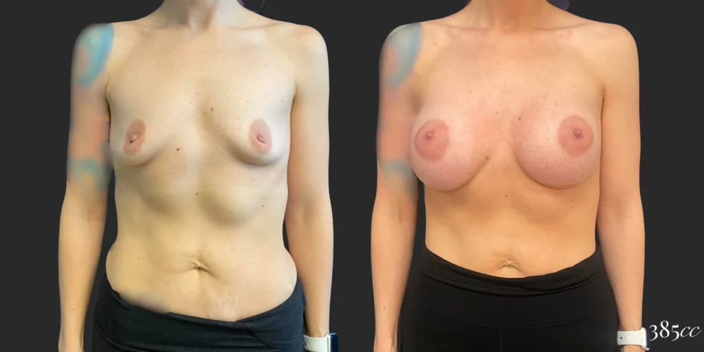 Breast Augmentation #124, before and after photo
