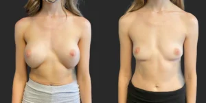 Breast Implant Removal #019, before and after photo