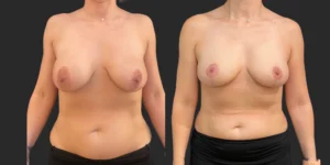 Breast Implant Removal #020, before and after photo