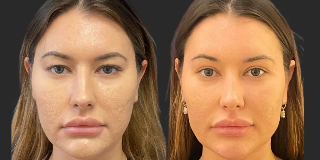 Upper Blepharoplasty #001, before and after photo