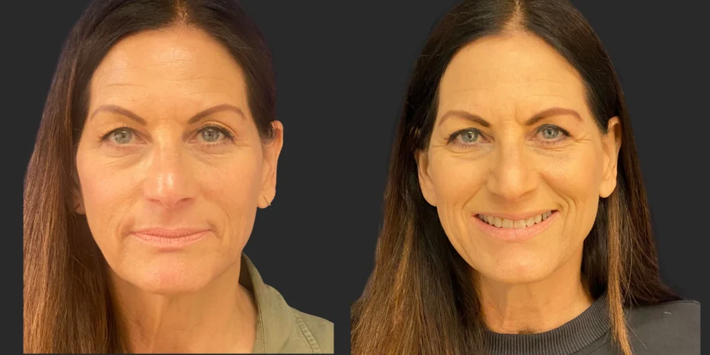 Upper Blepharoplasty #002, before and after photo