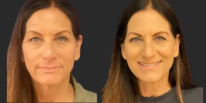 Upper Blepharoplasty #002, before and after photo