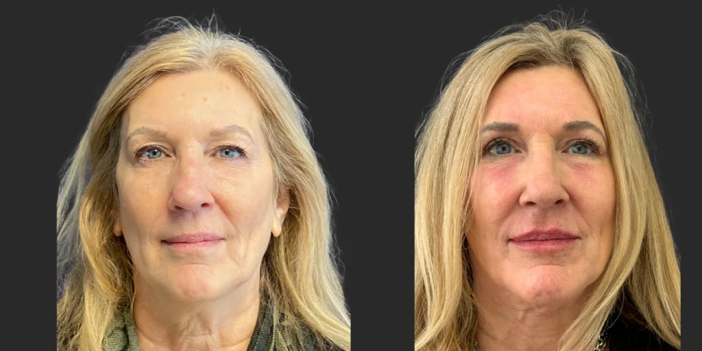 Cameo 2 and Rhinoplasty and Upper Blepharoplasty and Lip Fillers #003, before and after photo