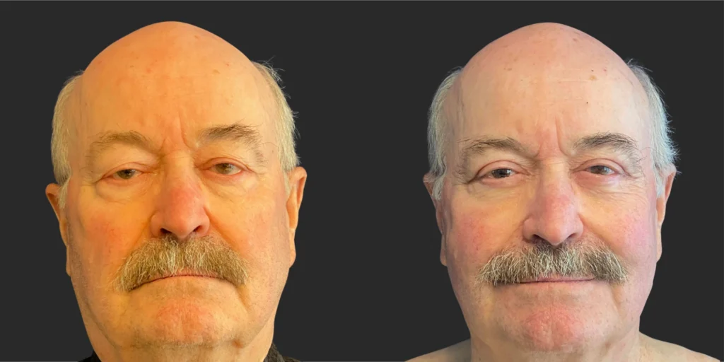 Upper Blepharoplasty #004, before and after photo