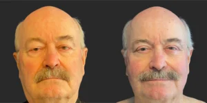 Upper Blepharoplasty #004, before and after photo