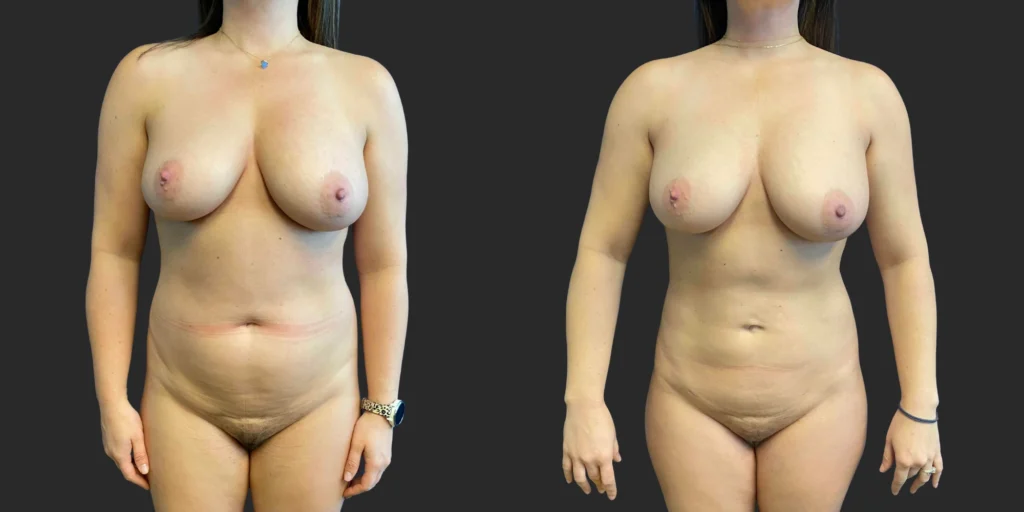360 Lipo #040, before and after photo