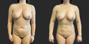 360 Lipo #040, before and after photo