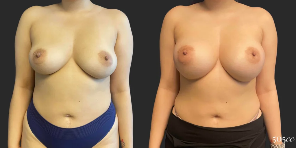 Breast Augmentation #106, before and after photo