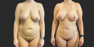 360 Lipo with Fat Transfer to Buttocks + Breasts #041, before and after photo