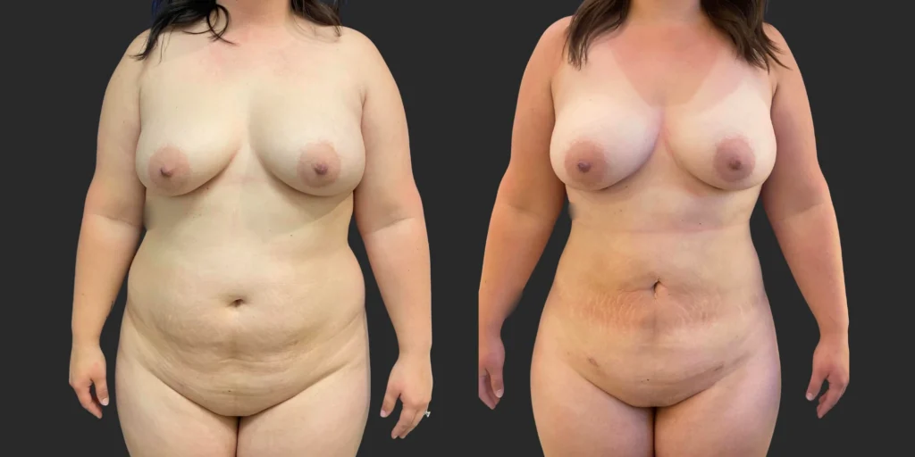 360 Lipo #042, before and after photo