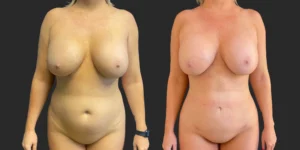 360 Lipo #044, before and after photo