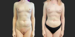 360 Lipo with Fat Transfer to Buttocks + Breasts #045, before and after photo