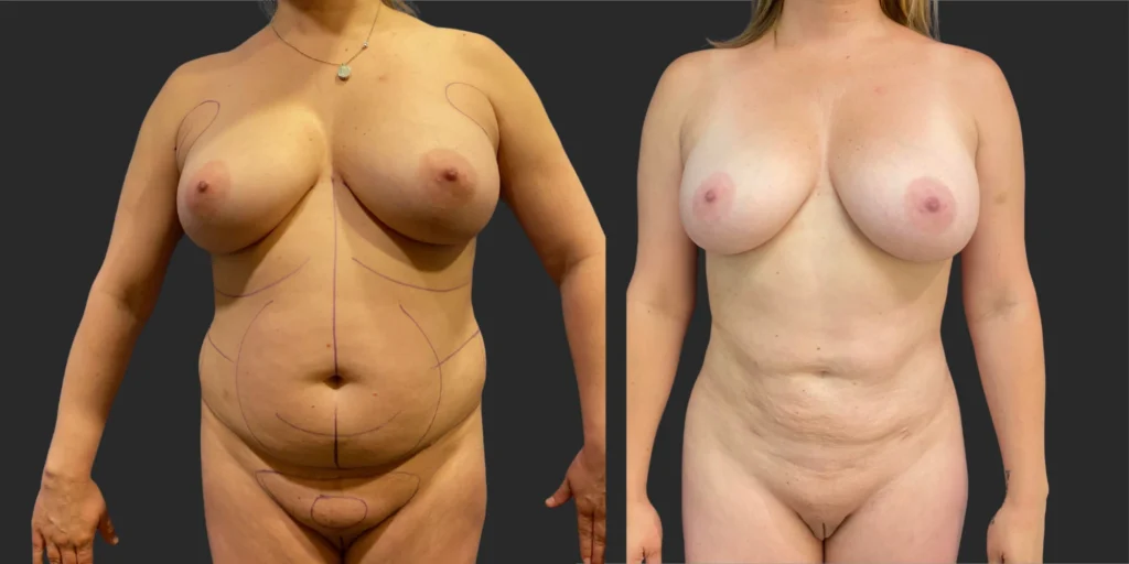 360 Lipo +Pubis #046, before and after photo