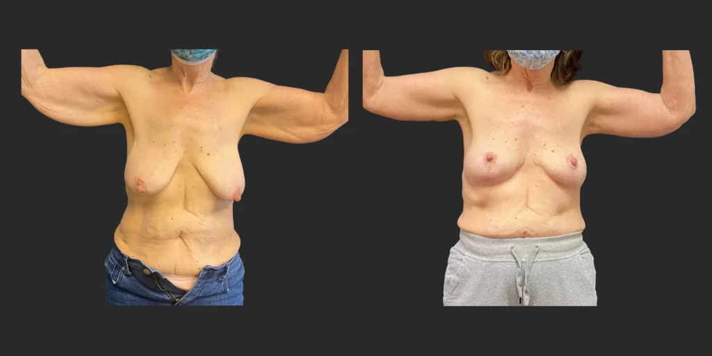 Arm Lift (Brachioplasty) #004, before and after photo