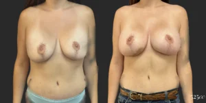 On Top® Pocket Change #12, before and after photo