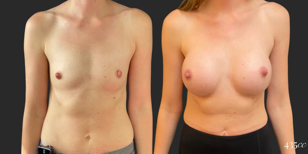 Breast Augmentation #101, before and after photo
