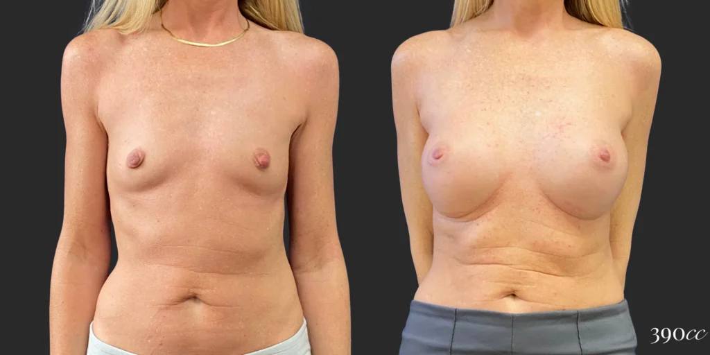 Breast Augmentation #102, before and after photo