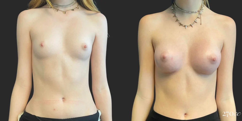 Breast Augmentation #107, before and after photo
