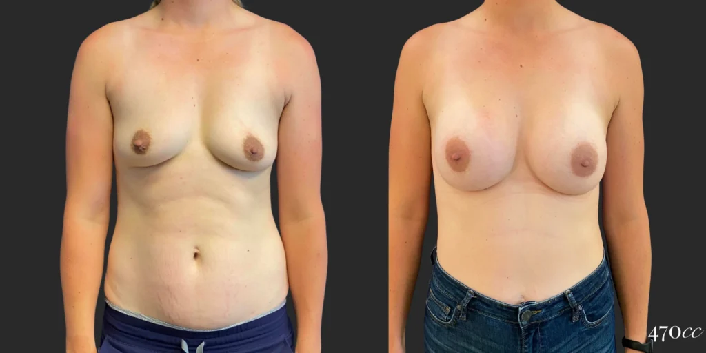 Breast Augmentation #108, before and after photo