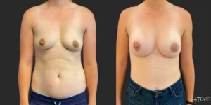 Breast Augmentation #108, before and after photo