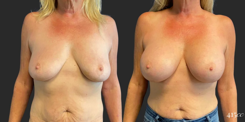 Breast Augmentation #109, before and after photo