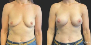 Breast Augmentation #111, before and after photo