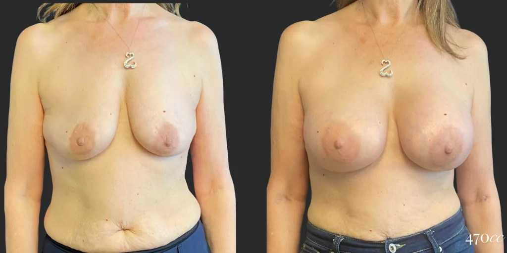 Breast Augmentation #112, before and after photo