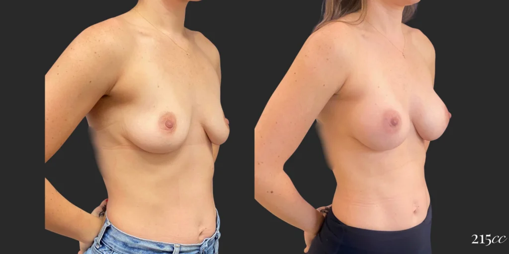 Breast Augmentation #103, before and after photo, view 2