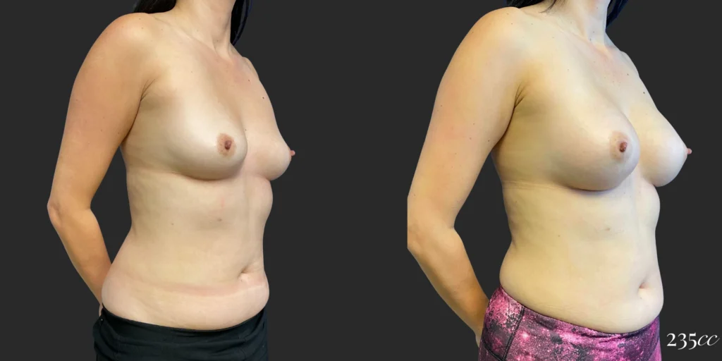 Breast Augmentation #114, before and after photo, view 2