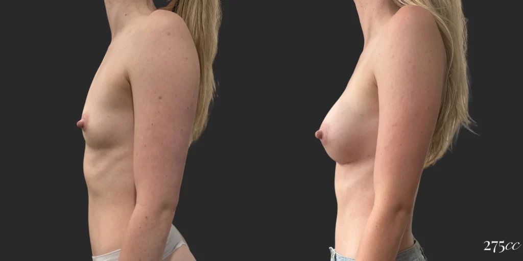 Breast Augmentation #115, before and after photo, view 2