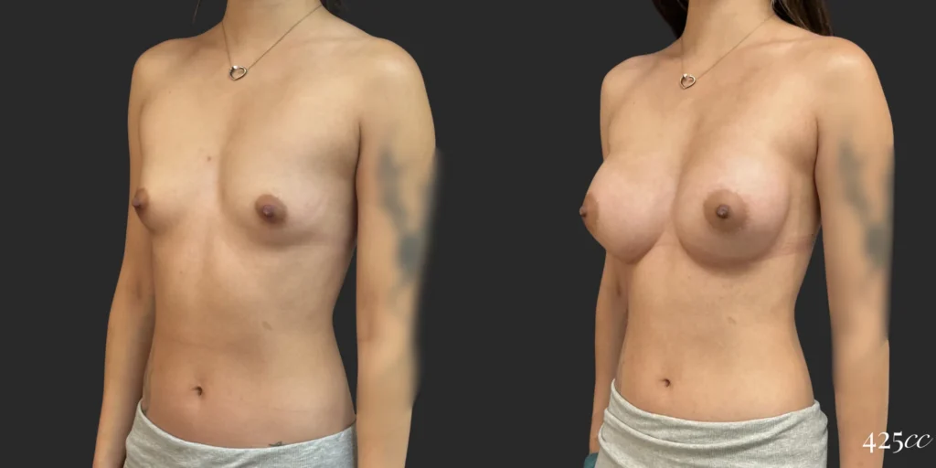 Breast Augmentation #116, before and after photo, view 2