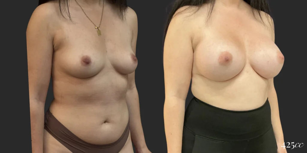Breast Augmentation #117, before and after photo, view 2