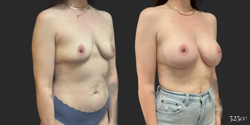 Breast Augmentation #119, before and after photo, view 2