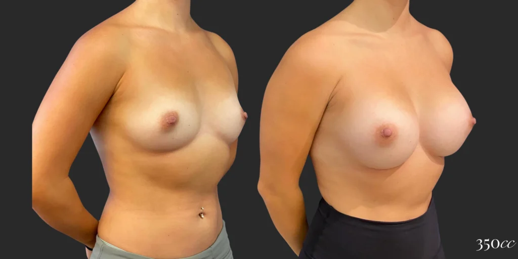 Breast Augmentation #122, before and after photo, view 2
