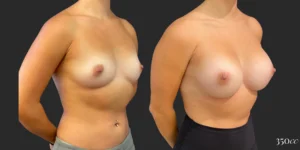 Breast Augmentation #122, before and after photo, view 2