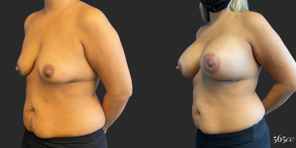 Breast Augmentation #105, before and after photo, view 2