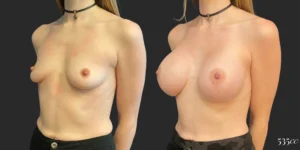 Breast Augmentation #123, before and after photo, view 2