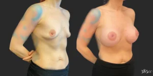 Breast Augmentation #124, before and after photo, view 2