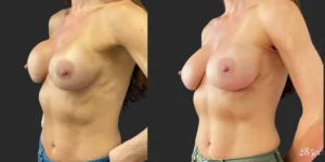 Bilateral Implant Exchange Revision #018, before and after photo, view 2