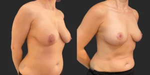 Breast Implant Removal #020, before and after photo, view 2